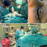 Blepharoplasty Surgeon Reviews